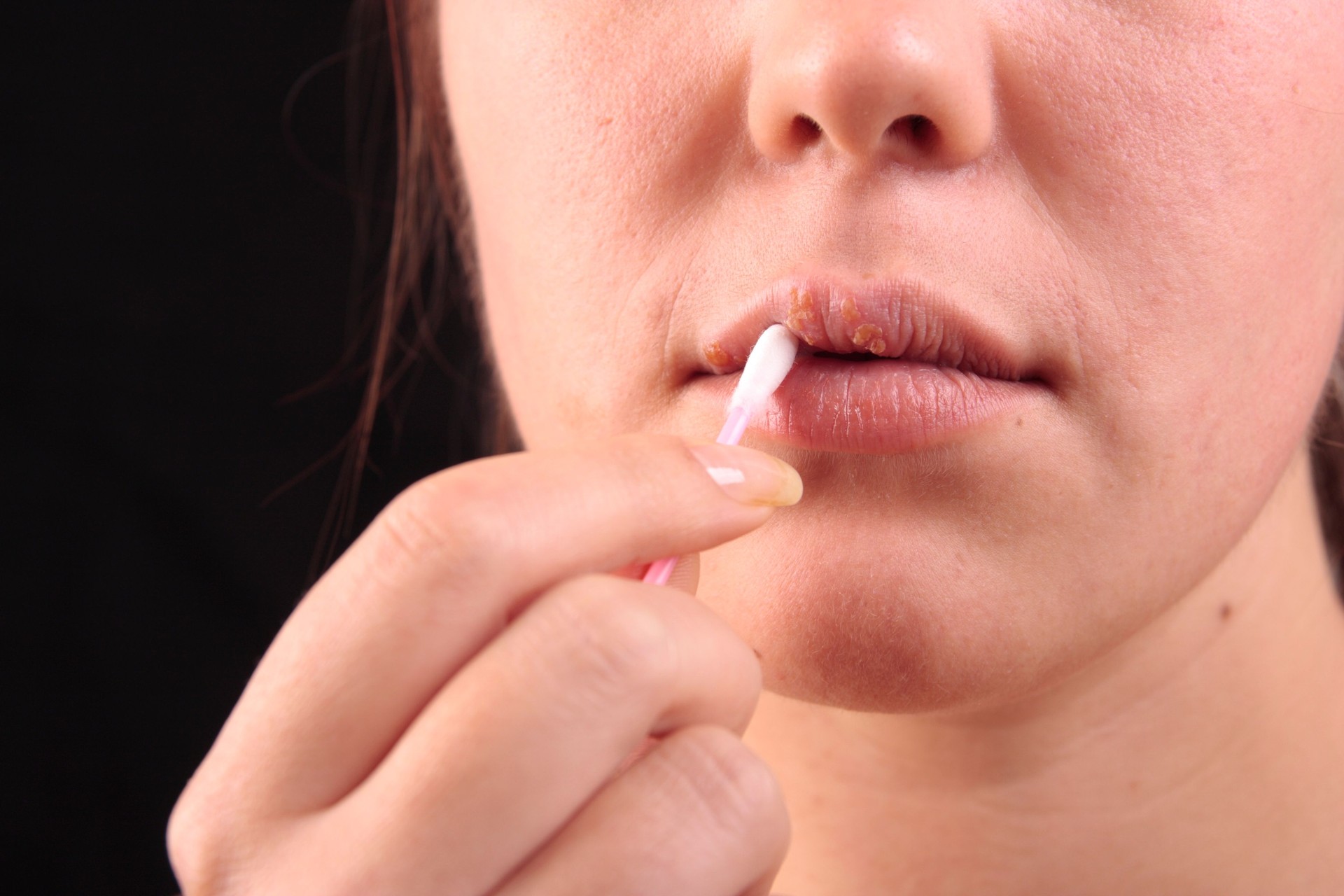 Woman applying medicine to cold sore with a cotton swab