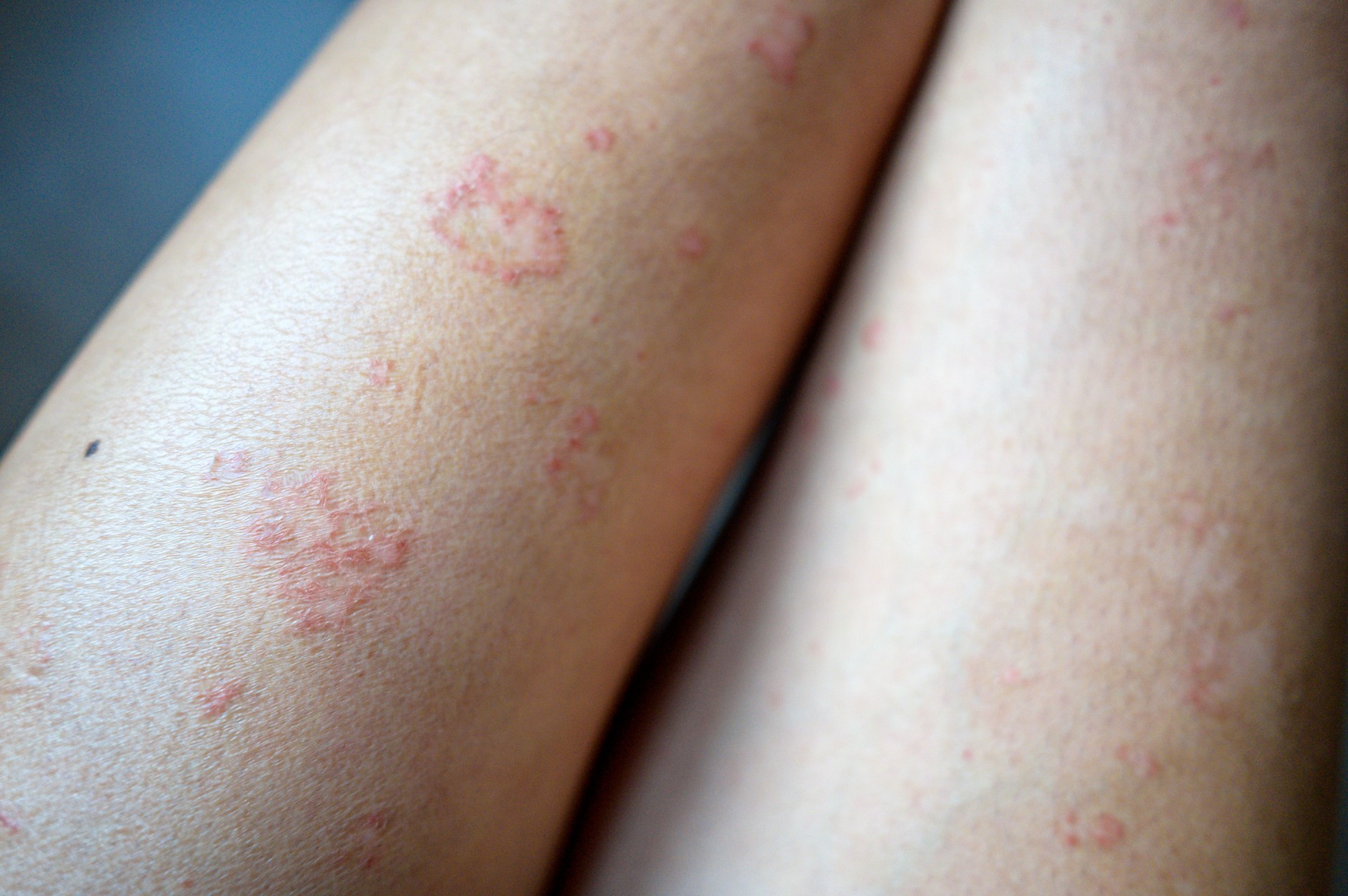 Asian legs and arm of Atopic dermatitis skin problem
