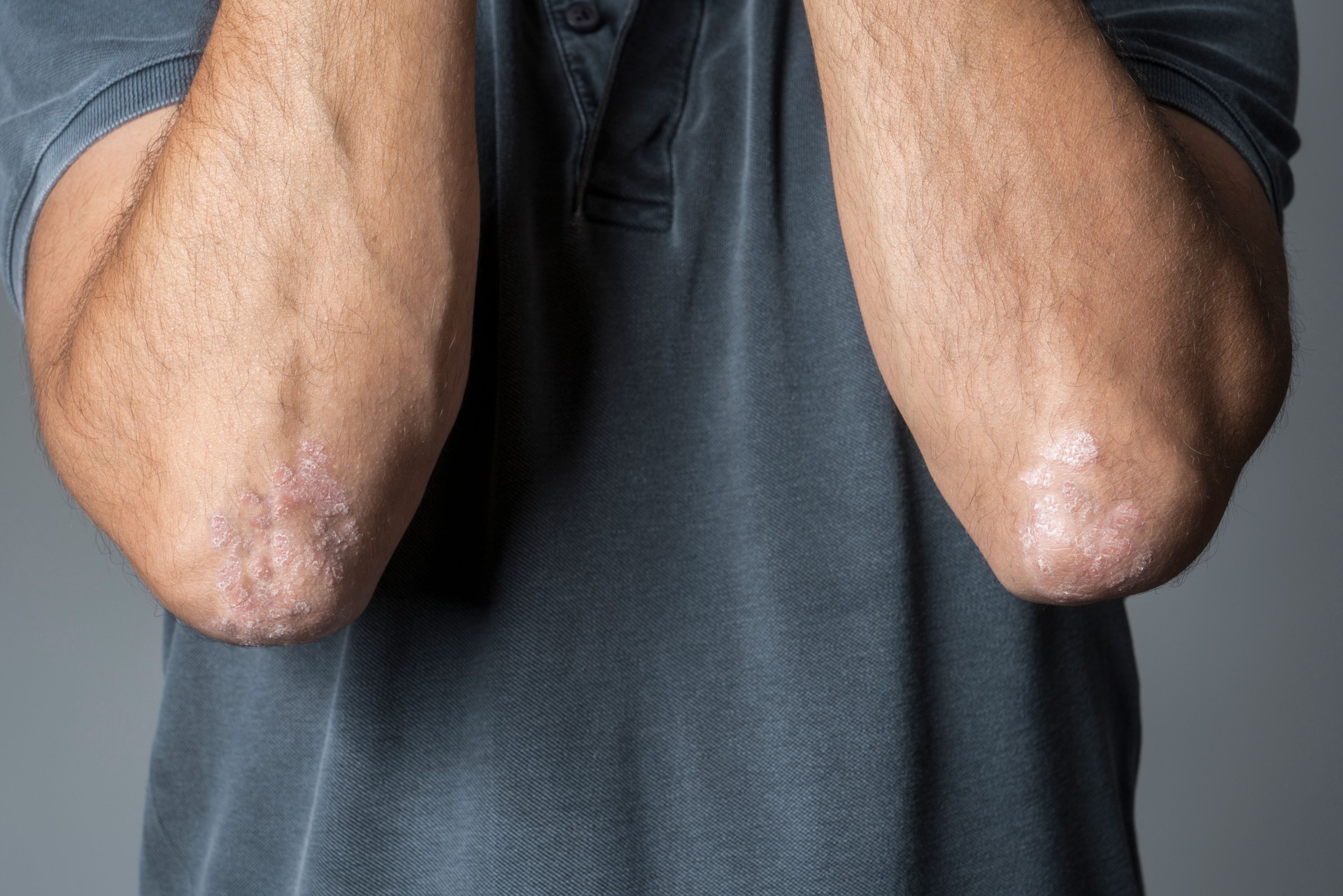 Man with psoriasis on his elbows