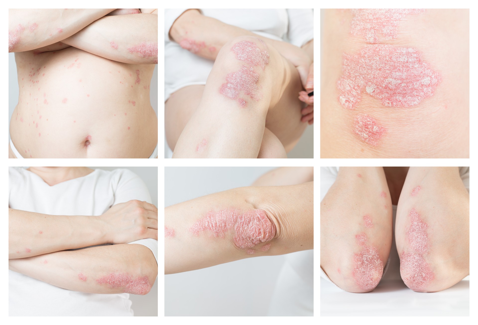 Multiphoto, collage of acute poriasis in various parts of the female body. An autoimmune, incurable dermatological skin disease. Large red, inflamed, scaly rash