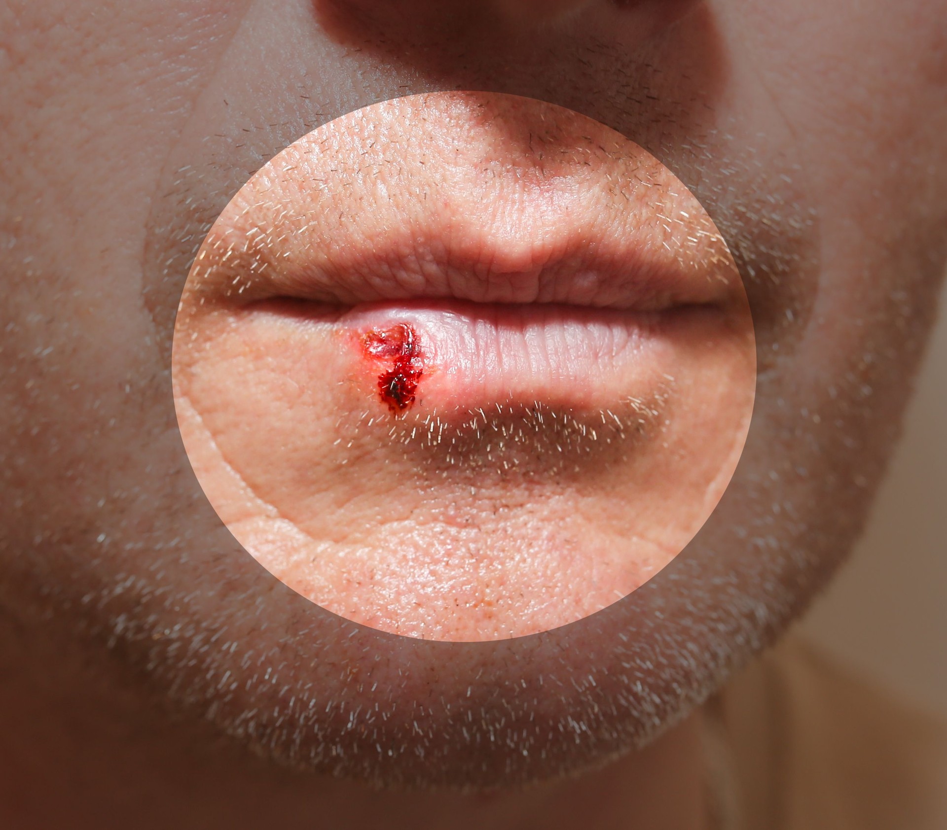 Herpes infection on the lips. Wound with blood on man's face. Medical care photo.